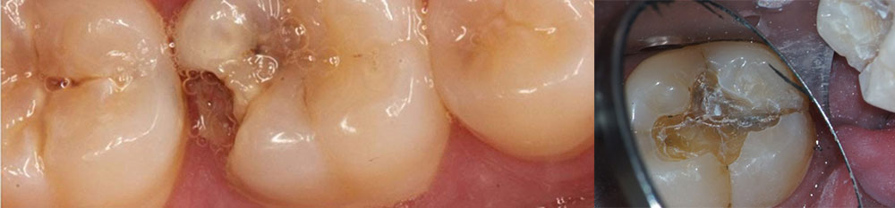 مضاعفات كسور الأسنان