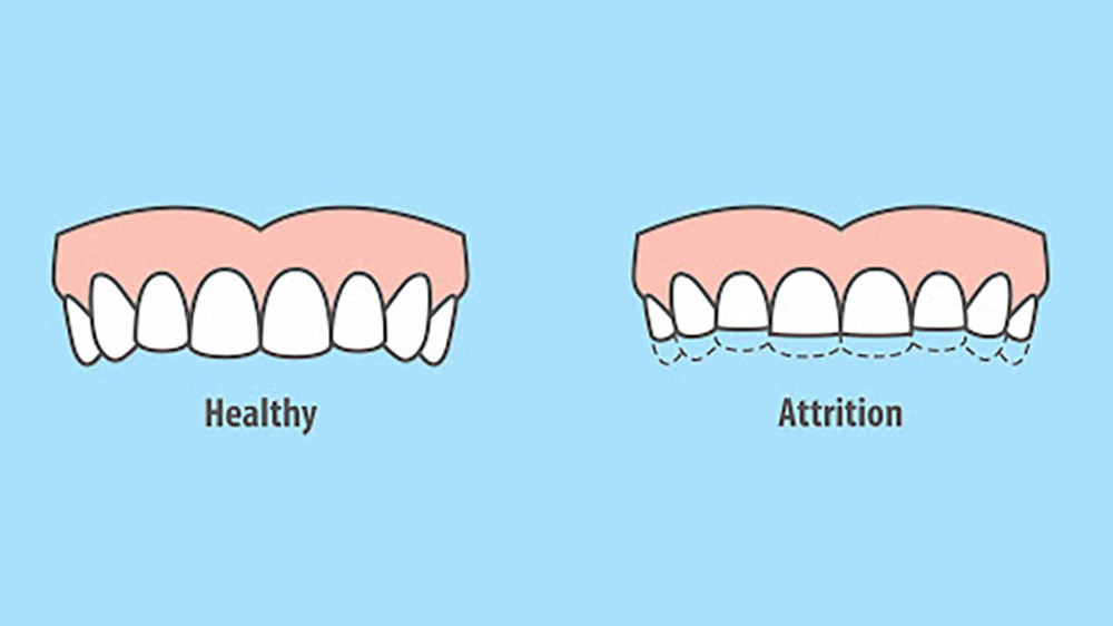 abgenutzte zähne aufgrund von bruxismus und gesunde zähne