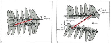 clii and occlusal plane angle
