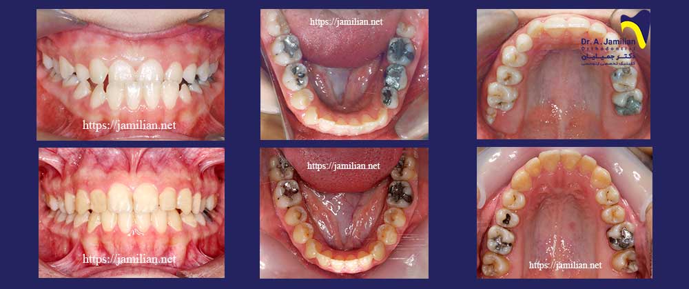 class3 malocclusion before after
