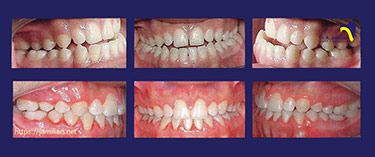 علاج تقويم الأسنان وجراحة تشوهات الدرجه الثالثه
