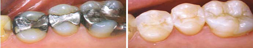 comparison of composite and amalgam filling