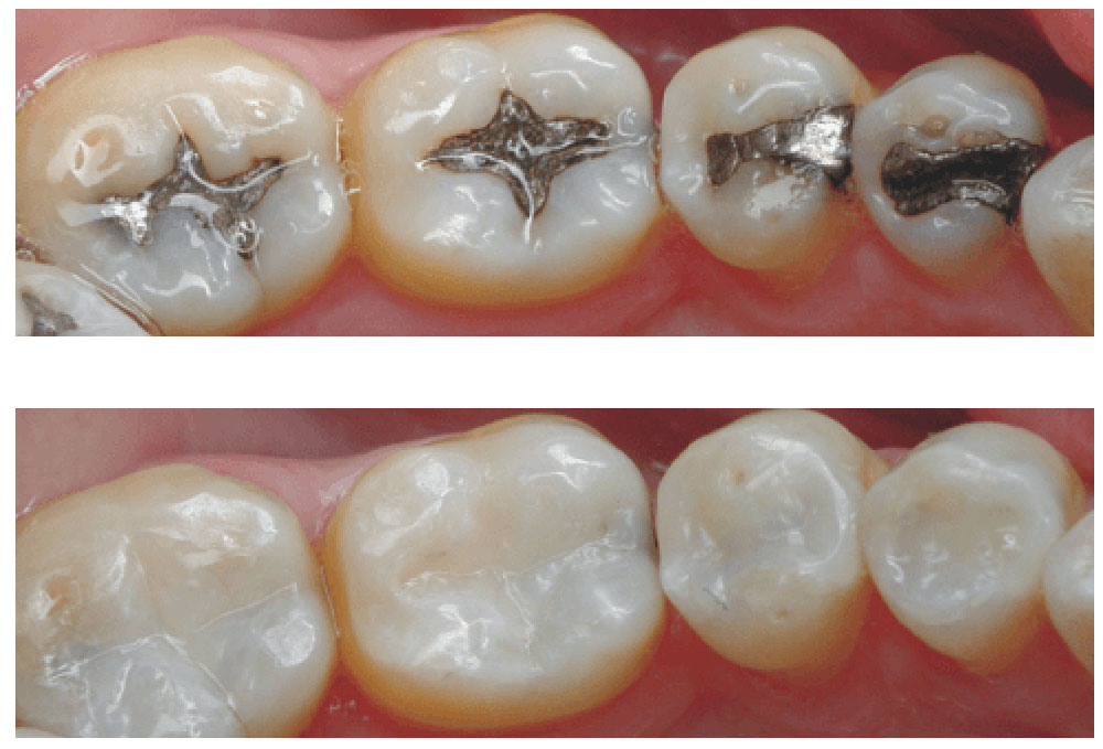 composite teeth fillings