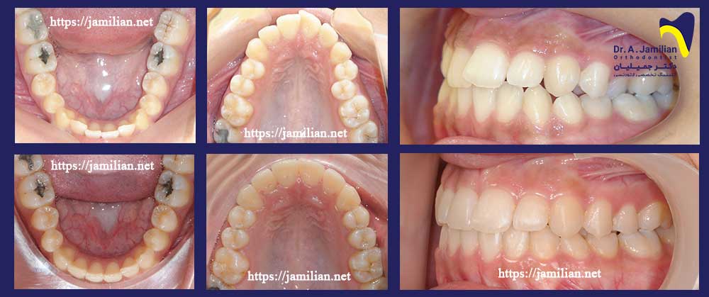 علاج نمو الفك مع تقويم الأسنان