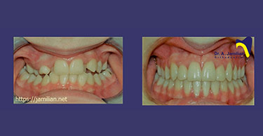 قبل و بعد علاج تقویم الاسنان مع کراس بایت قدامیه و خلفی مع صخب الاسنان