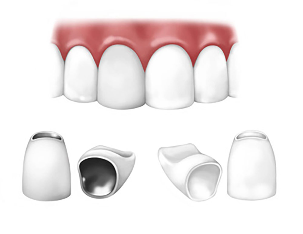 dental crown types