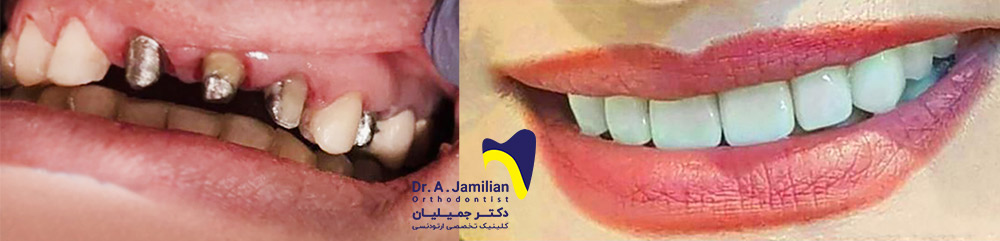 Vor und nach zahnimplantaten