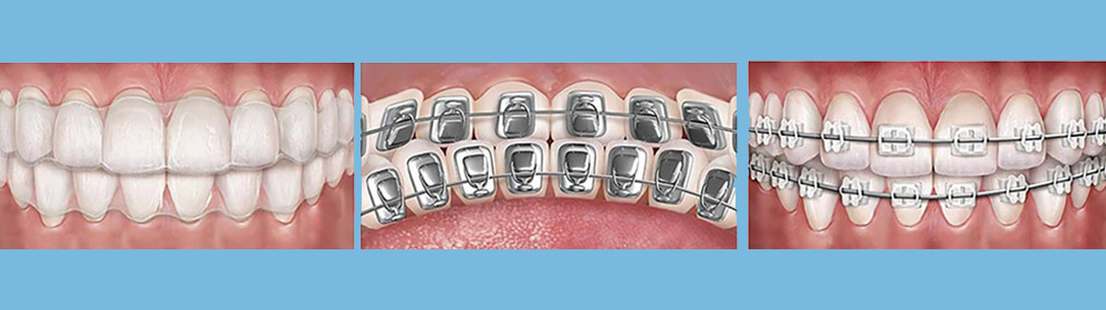 different types of invisible orthodontic treatment