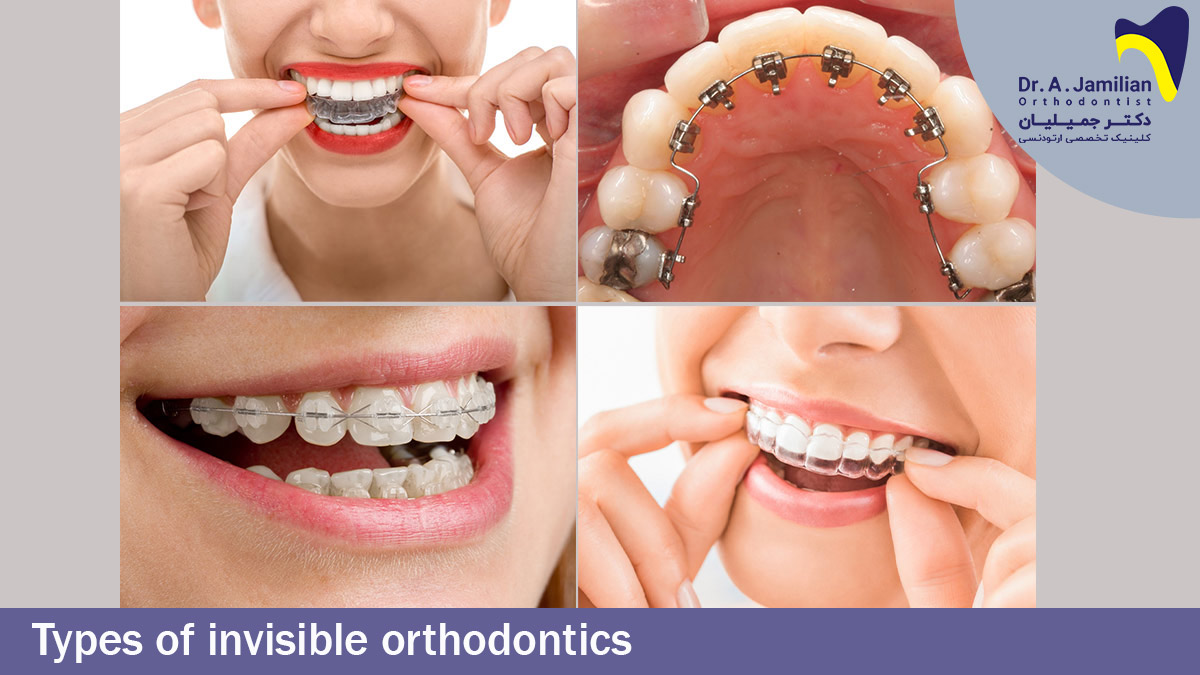 Types of invisible orthodontic - Dr Jamilian