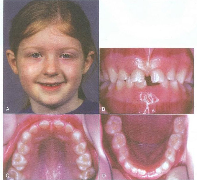 مراحل اولیه تکامل دندان دائمی