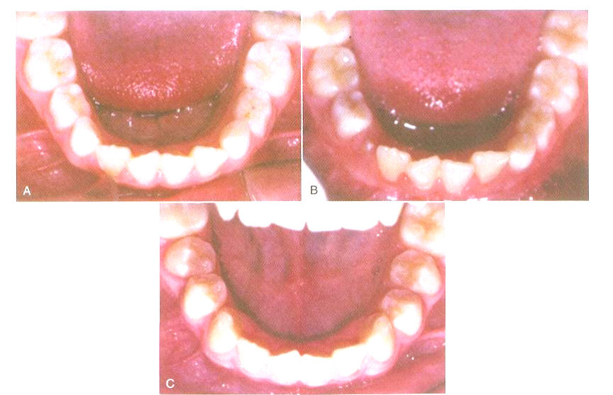 مراحل اولیه تکامل دندان دائمی