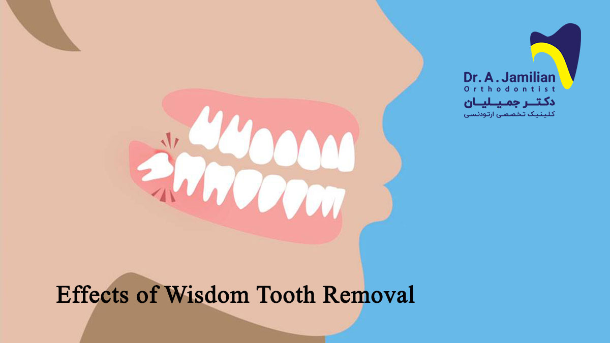 Wisdom Teeth In Arabic