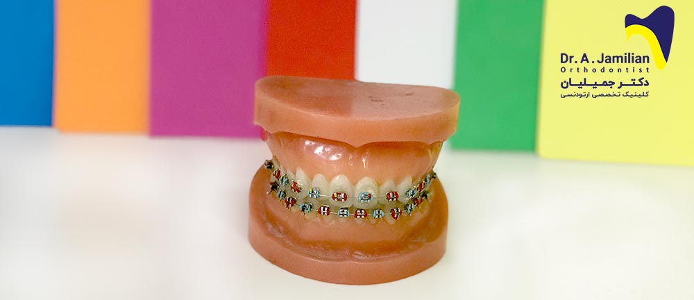 fixed orthodontic procedure