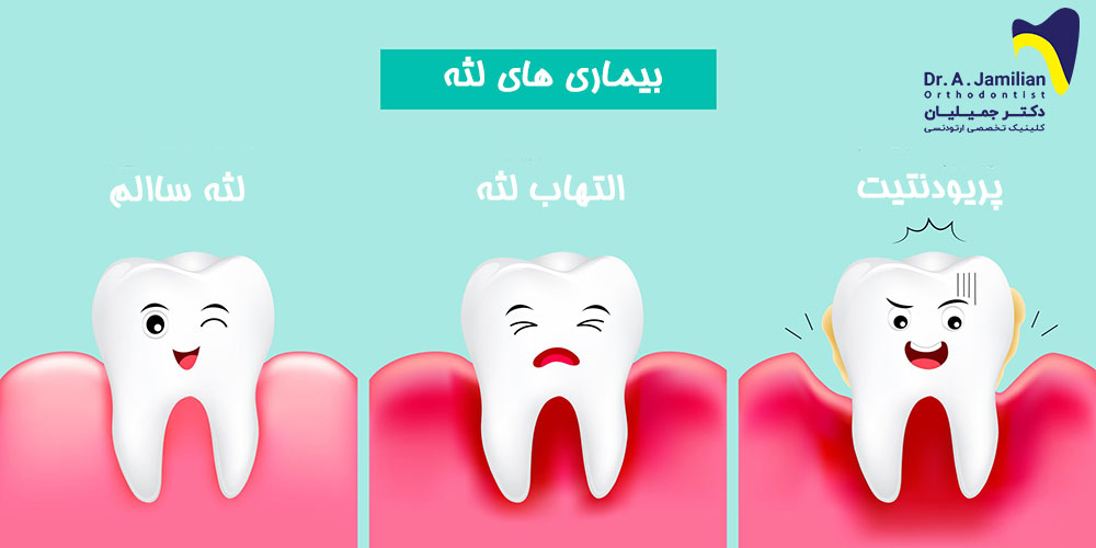 stadien der zahnfleischerkrankung