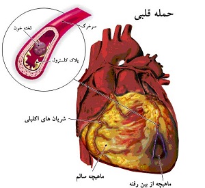 سکته قلبی