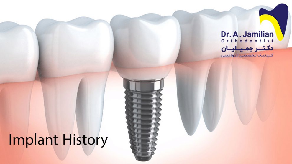 Implant History - Dr Jamilian