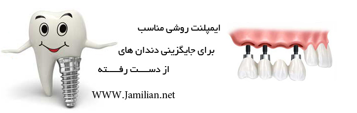 ایمپلنت