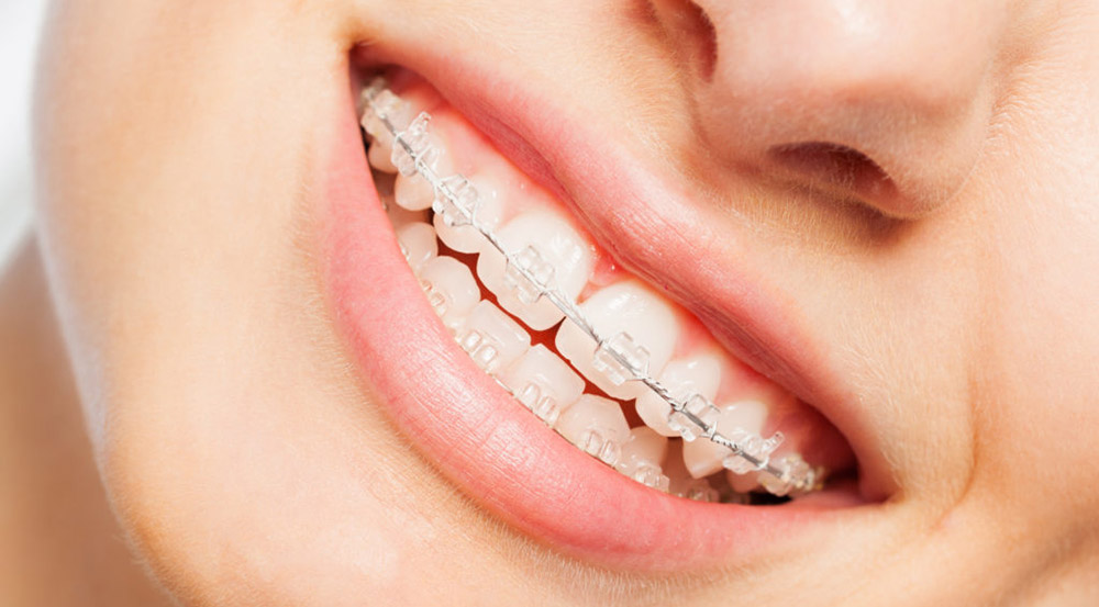 تقويم الأسنان غير المرئي مع قوس سيراميك بلون الأسنان