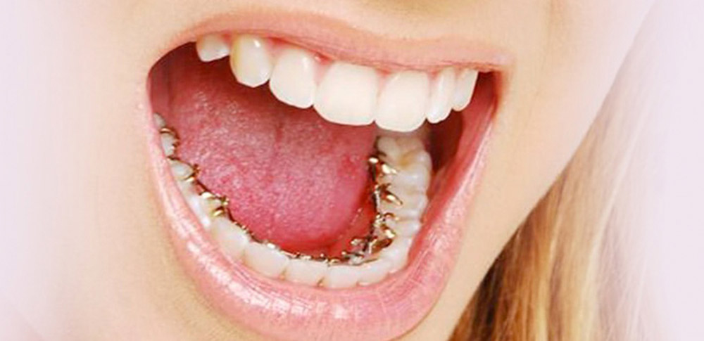 Unsichtbare linguale Kieferorthopädie an den unteren Zähnen des Patienten