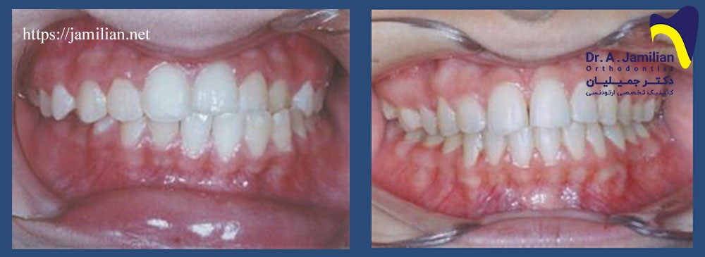 علاج انحراف الفك السفلي بتقويم الأسنان