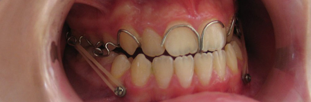 mini screws orthodontics appliences