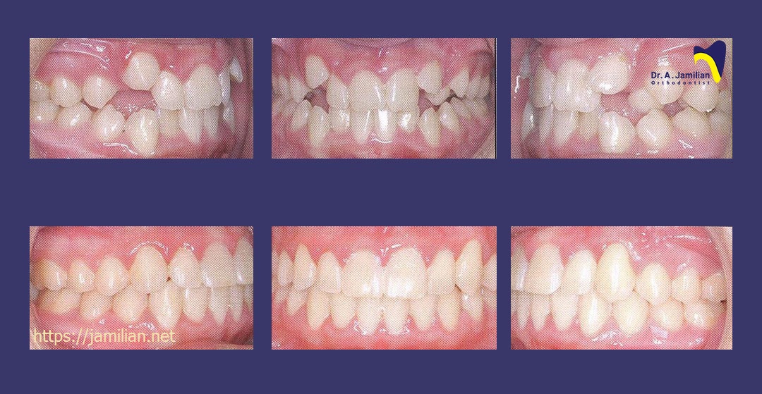 vor und nach der kieferorthopädischen zahnbehandlung