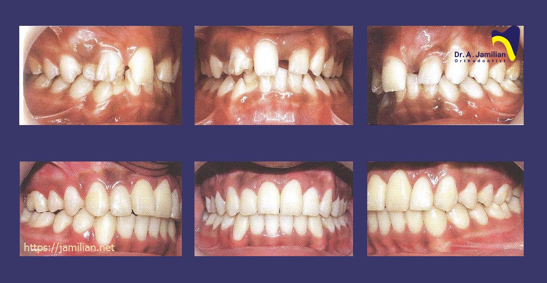 درمان ارتودنسی دندان غایب