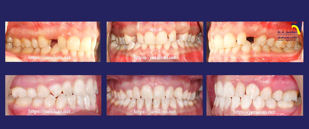 علاج تقويم الأسنان عدم نمو الاسنان