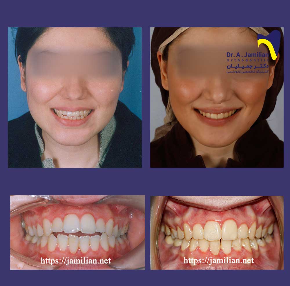 الصور قبل و بعد تقویم الاسنان اپن بایت