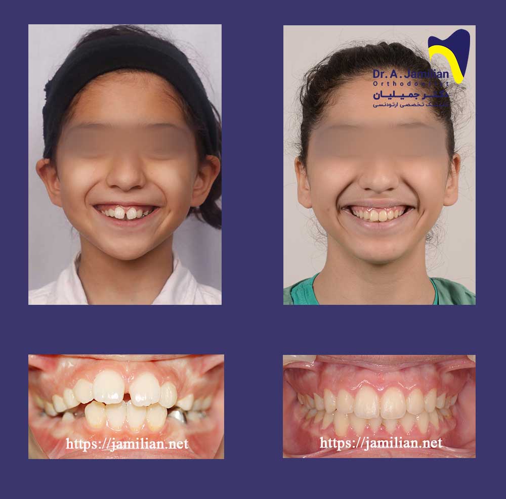 orthodontic treatment for openbite