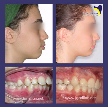 تغییرات دندان قبل و بعد از ارتودنسی