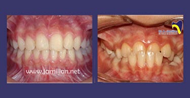 orthodontic treatment before and after