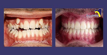 الصور قبل و بعد تقویم الاسنان