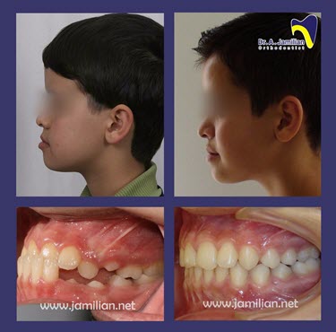 braces before and after face shape