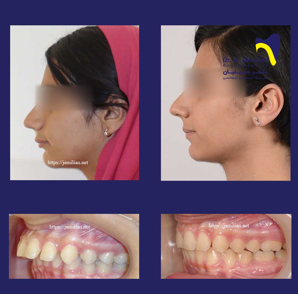 overjet orthodontic treatment