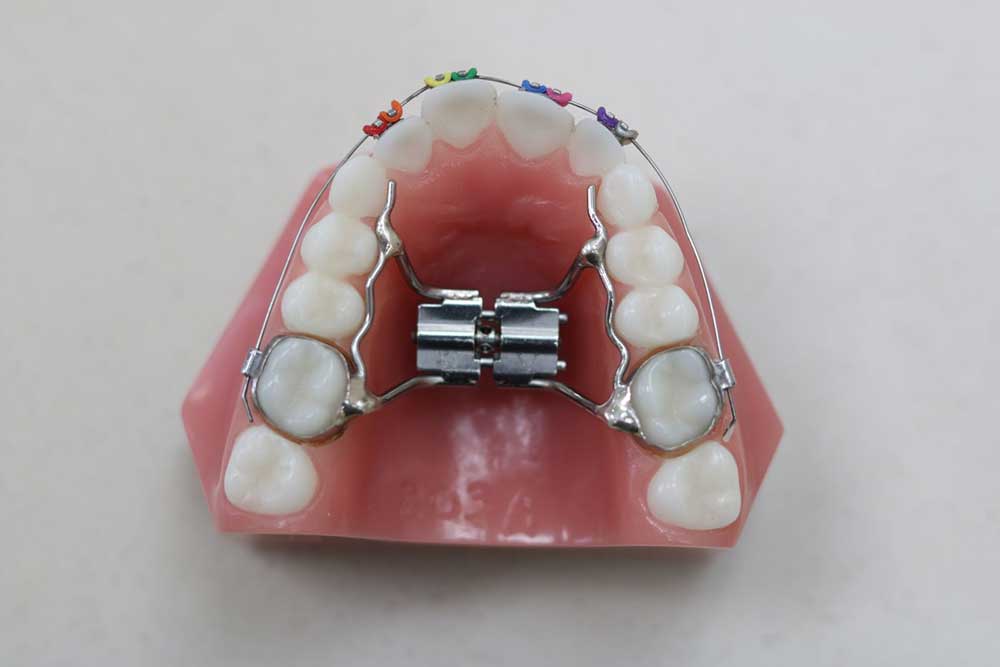 أجهزة تقويم الأسنان الموسعة للحنك