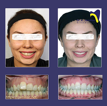 قبل و بعد علاج تقویم الاسنان فی المریض مع نمو المفرط اسنان الفک العلوی مع صخب الاسنان