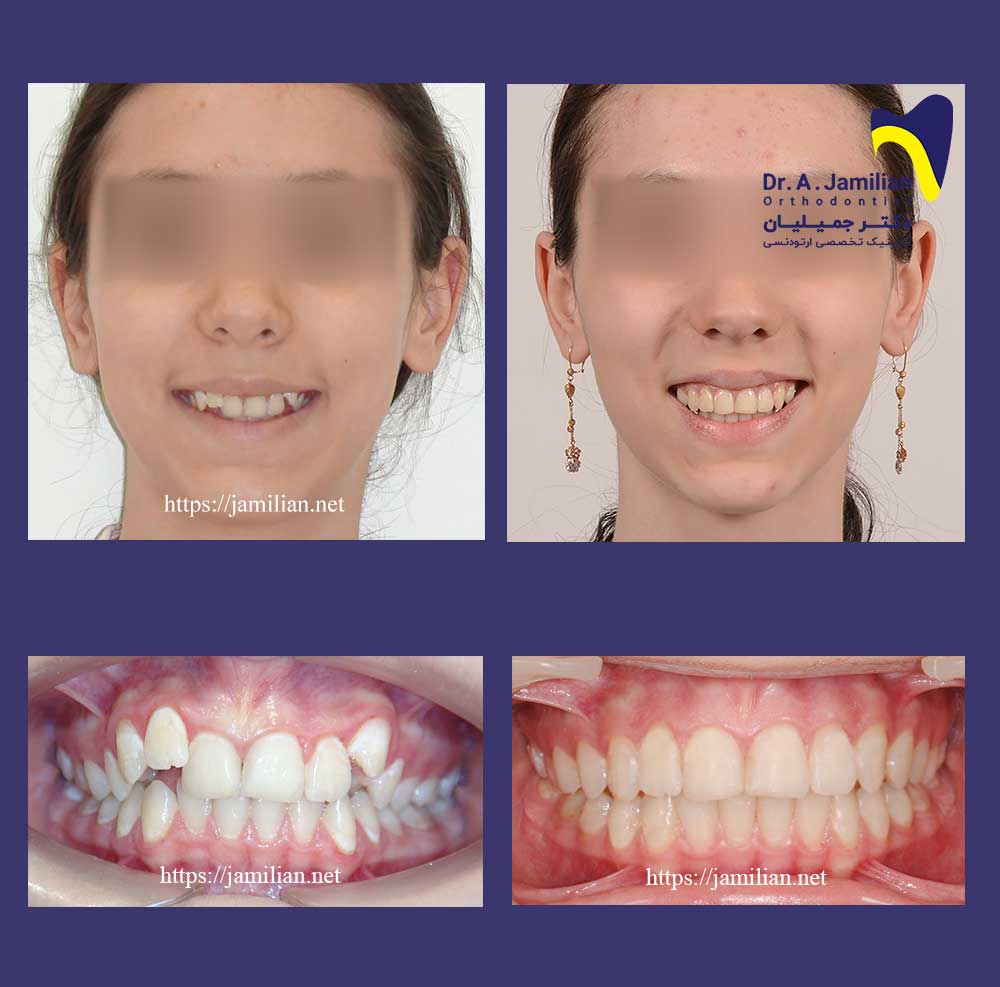 قبل بعد ارتودنسی شلوغی دندان