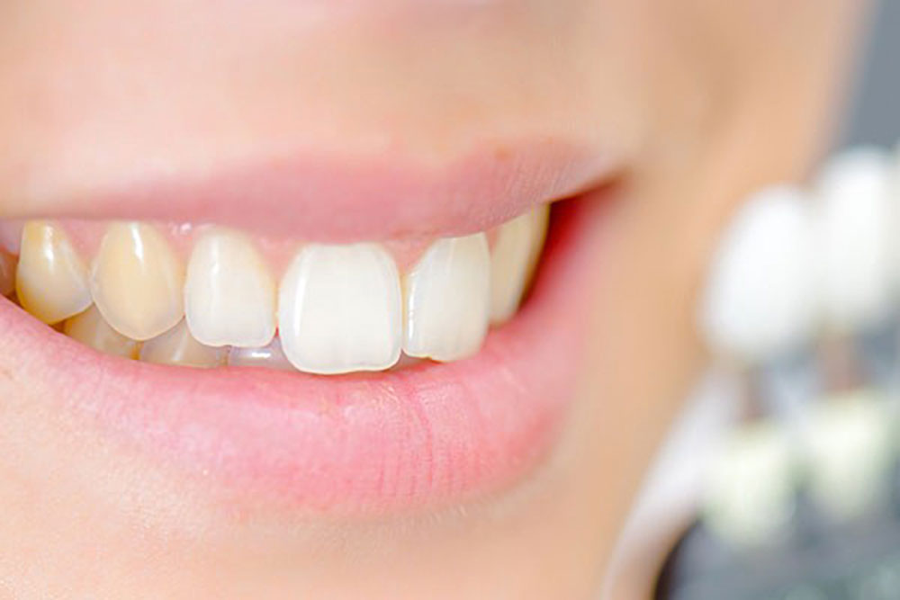 جلوگیری از زردی دندان