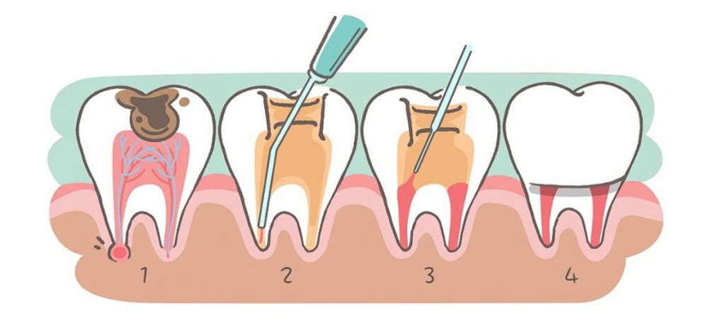 خطوات معالجة لب الأسنان وقناة جذر السن