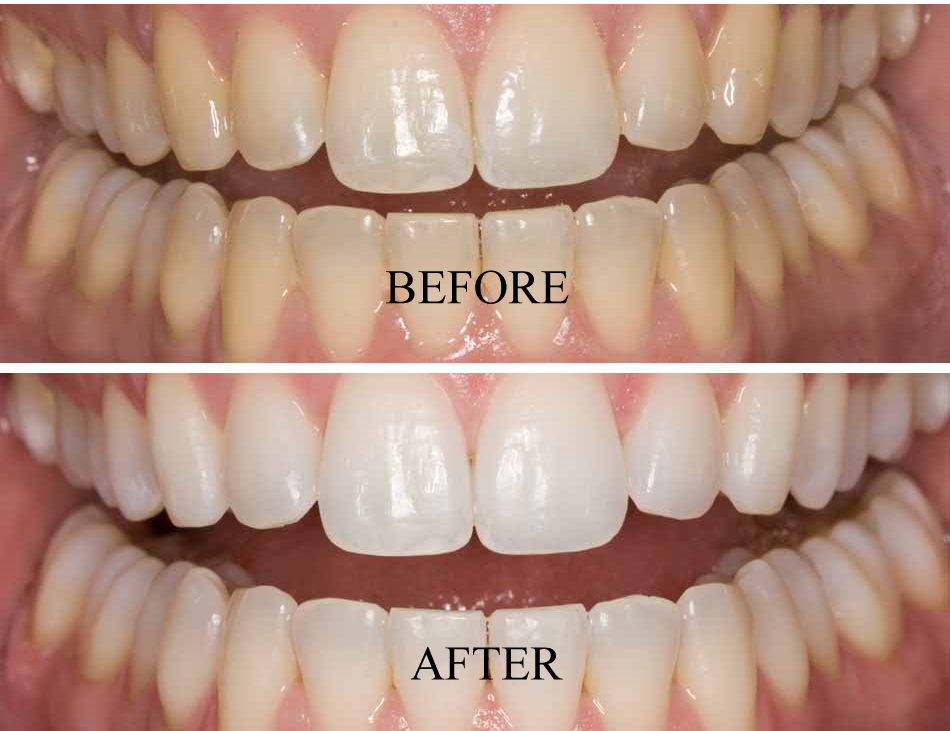 قبل و بعد سفید کردن دندان