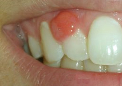 tooth abscess
