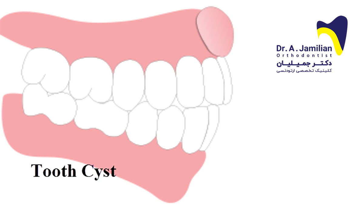 Dental Cysts - Dr Jamilian
