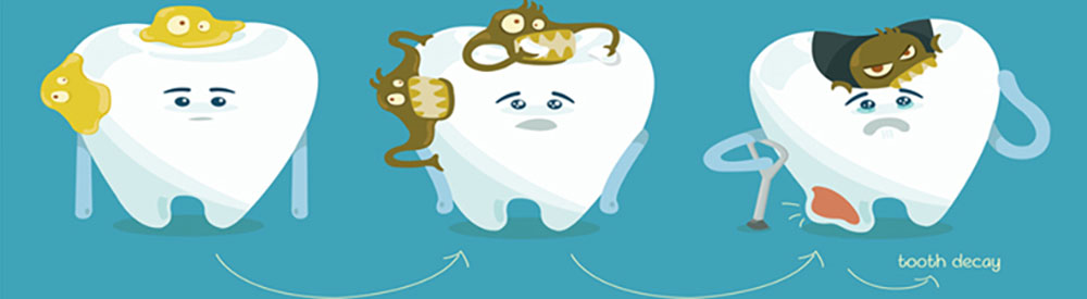 tooth decay diagnosis