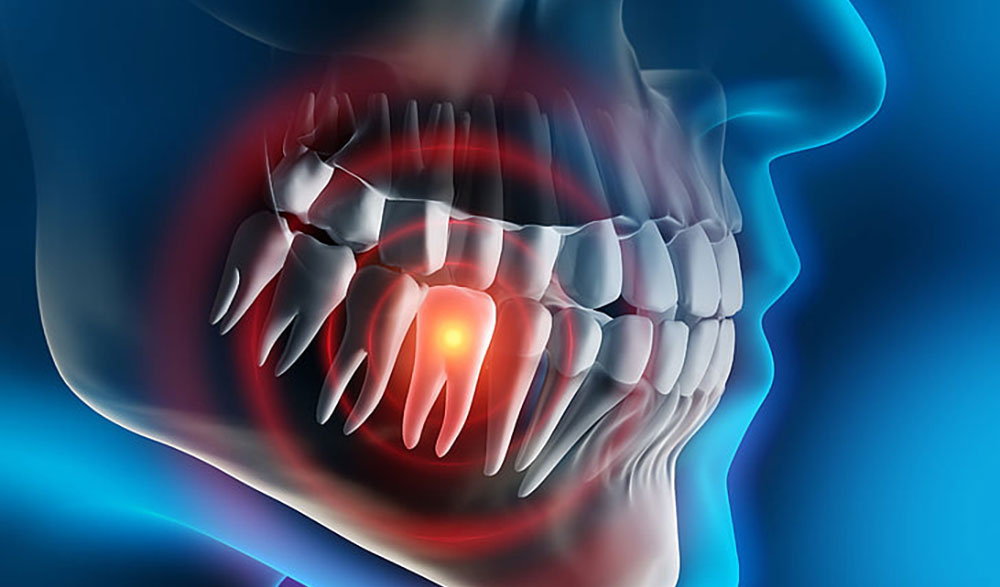 أعراض عدوى الأسنان