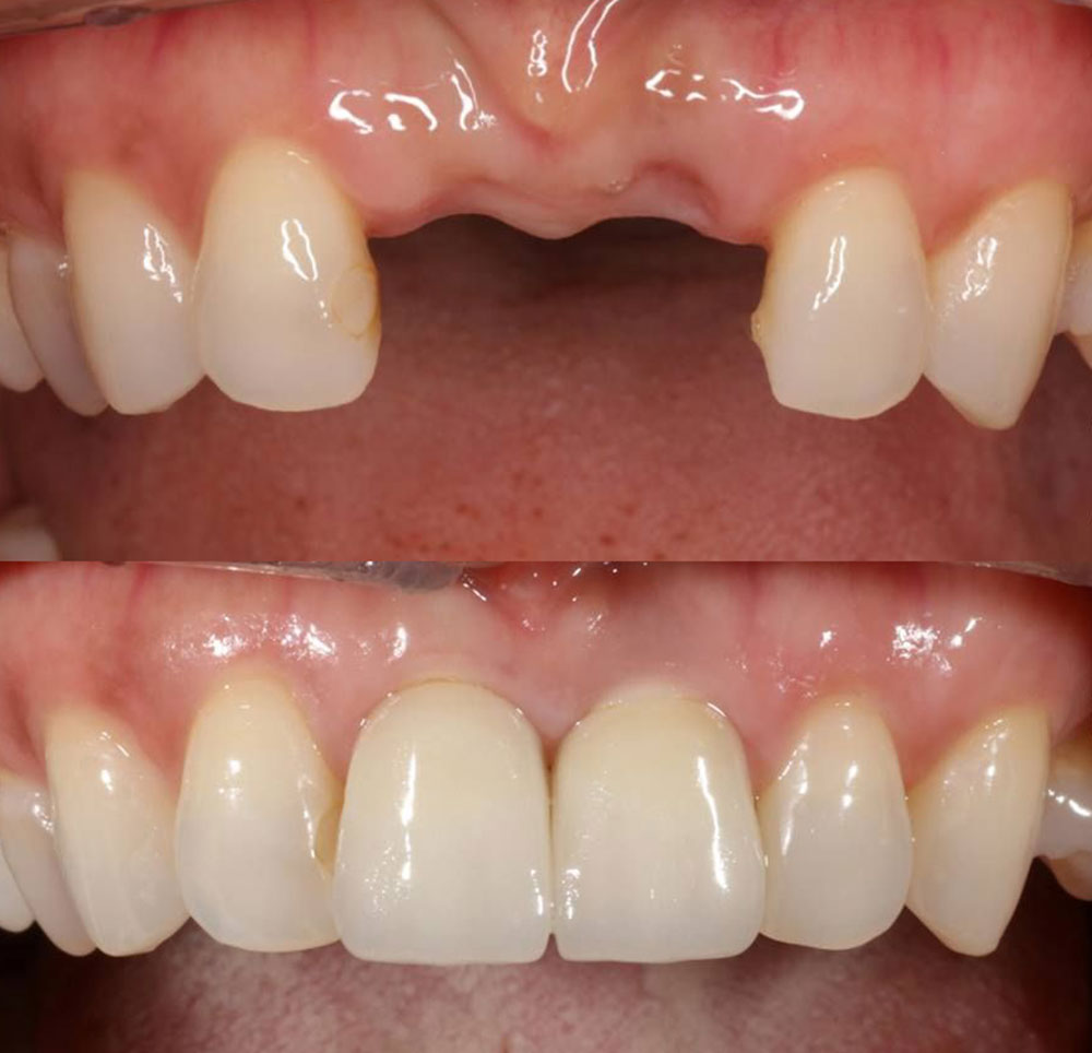before after replantation of teeth