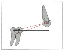 type of tooth movement