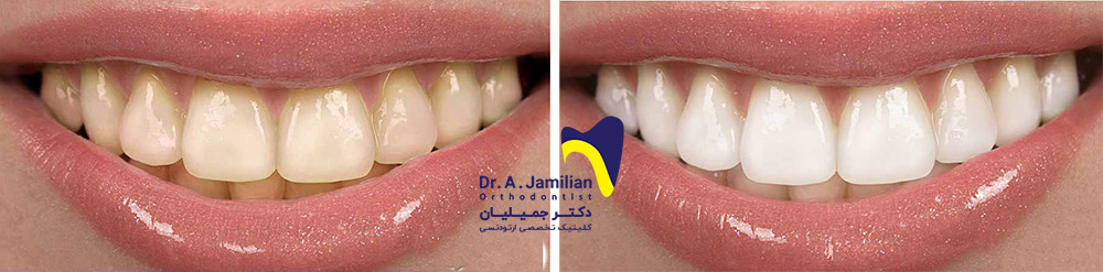 Vor und nach der Zahnaufhellung