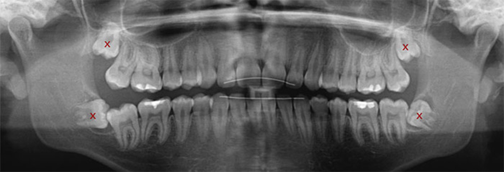 عکس ایکس ری از دندان عقل