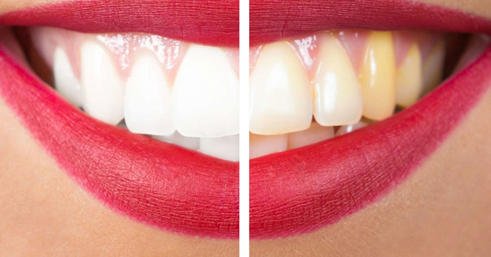 قبل و بعد درمان زردی دندان